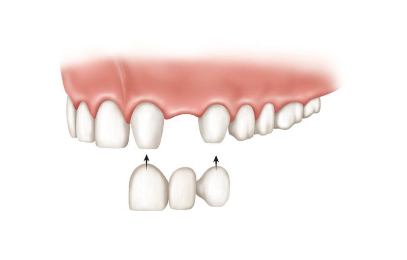 tooth supported bridge