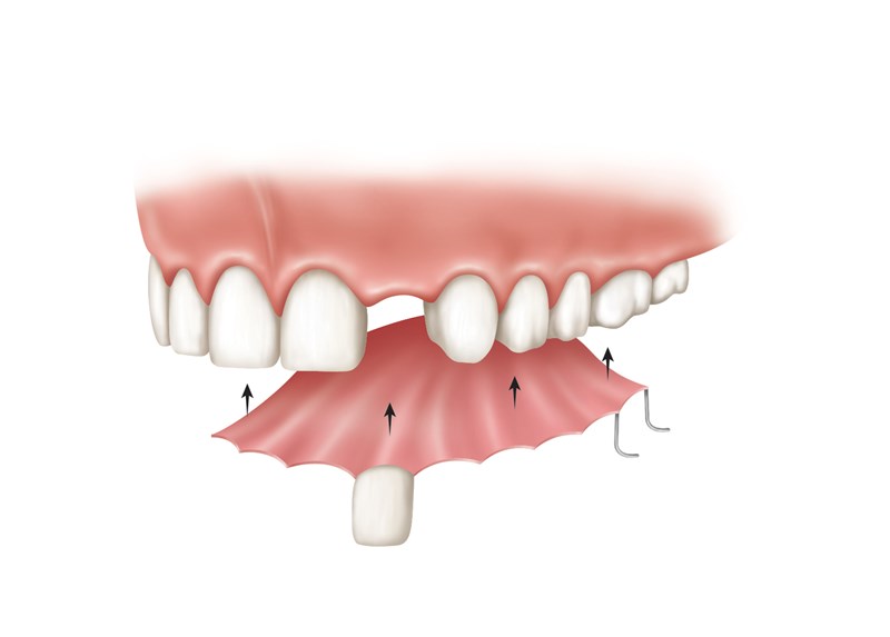 removable partial denture