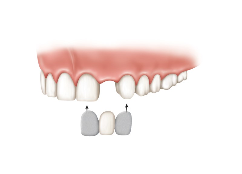resin bonded bridge