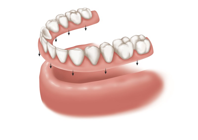 complete removable denture