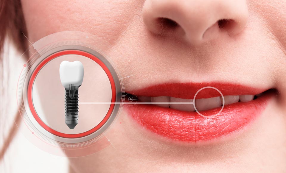 Beautiful Dental Implants